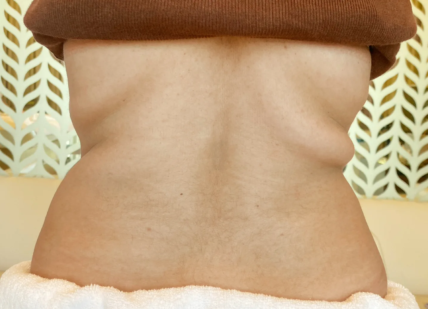 Before: Lower back and flanks
