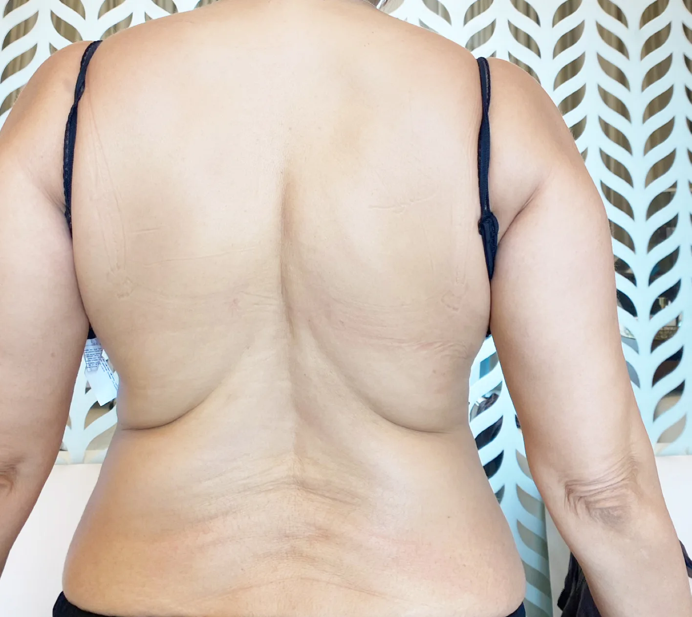 Before: Back contouring